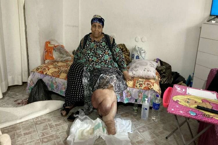 Bacakları şişip iltihaplanan kadın tedavi olmak istiyor haberinin görseli