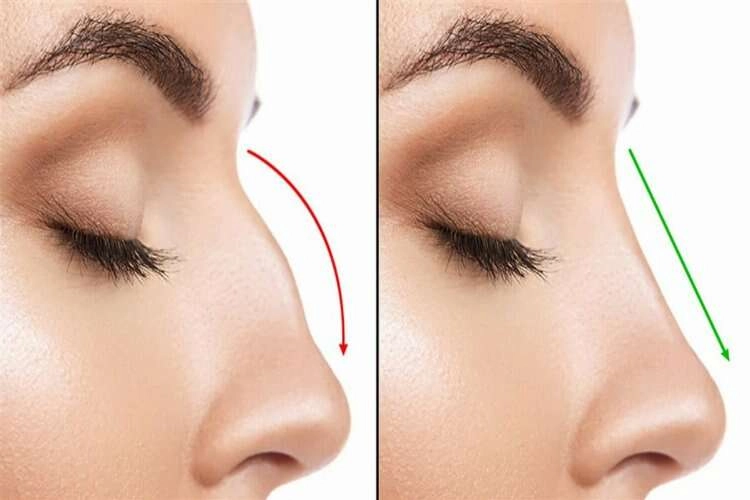 Ultrasonik burun estetiğinde çekiçle kırmaya son haberinin görseli