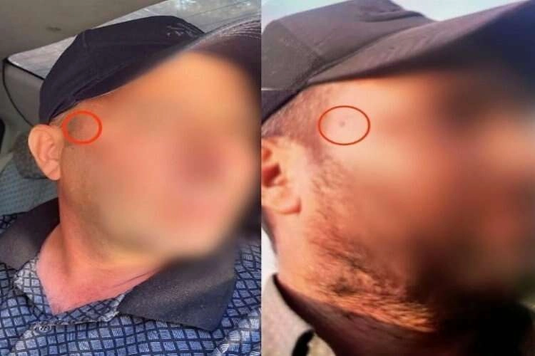 Jandarmaya yakalanmamak için yüzündeki beni aldırdı haberinin görseli