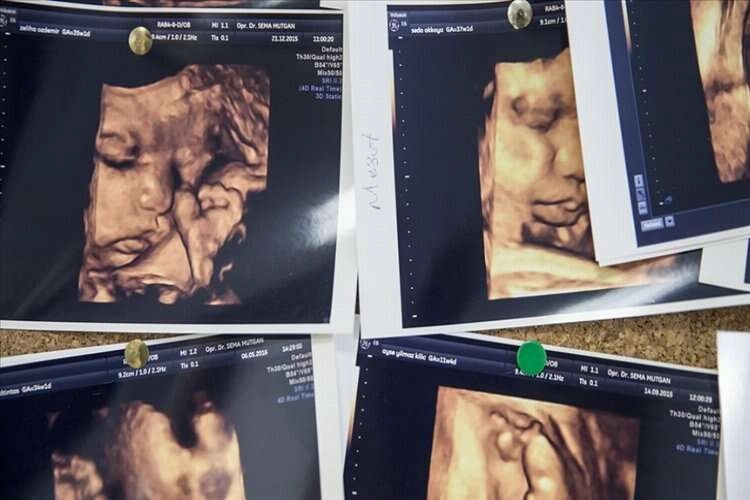 Çoğul gebelik oranları dünya genelinde artışa geçti haberinin görseli