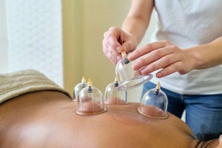 Hacamat nedir, nasıl yapılır? Hacamat noktaları nereler? haberinin görseli