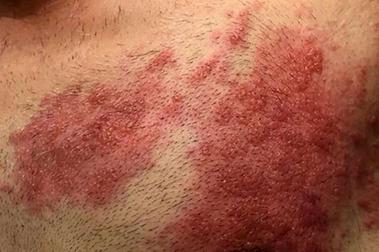 Viral hastalıklar coştu: Kızamık ve Zona’ya dikkat haberinin görseli