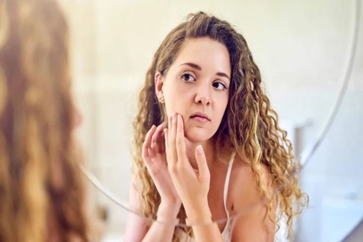 Akne Nedir? Akne Neden Çıkar? Akneyi yok etmek için neler kullanılır? haberinin görseli