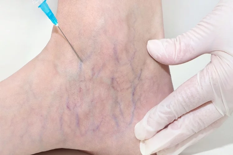 Varis nedir? Varis neden oluşur? Tedavisi var mıdır? haberinin görseli