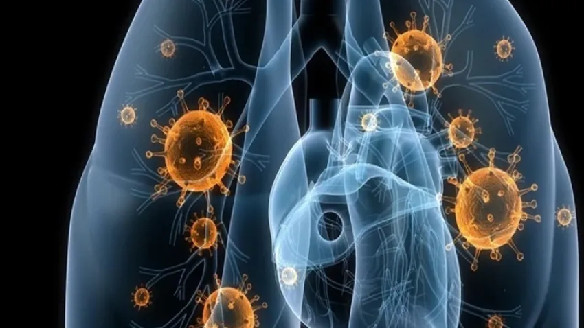 En yüksek ölüme yol açan enfeksiyon zatürre haberinin görseli