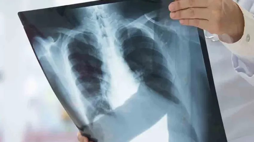 “Zatürre Türkiye’de ölüm nedenleri arasında 5’inci sırada” haberinin görseli