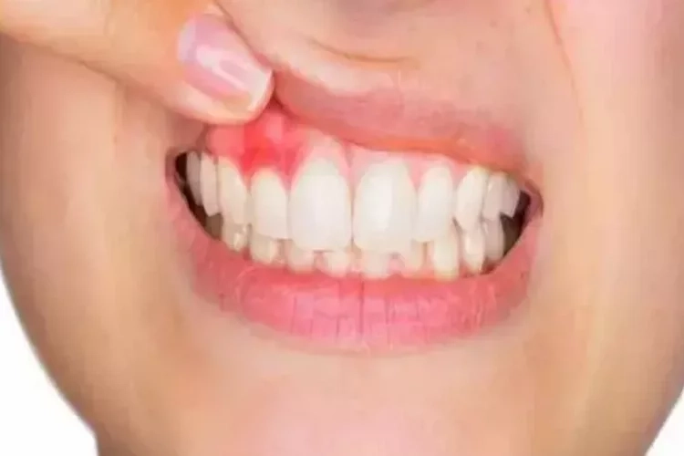Diş problemleri, şeker hastalığını etkiler mi? haberinin görseli