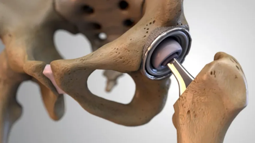 Şiddetli ağrıyla başlar, kalça protezi gerektirebilir haberinin görseli