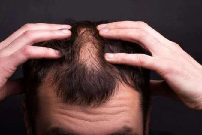 Alopeci Universal hastalığı nedir? Alopesi universalis tedavisi nasıldır?  Alopeci universalis belirtileri nedir?