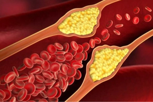 Kolesterol nedir? Vücutta kolesterol neden olur?