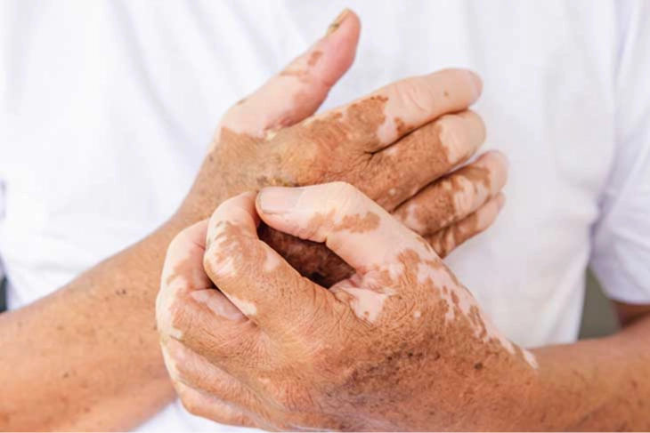 Vitiligo nedir, tehlikeli bir hastalık mıdır?