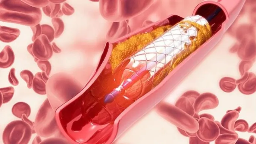 Dr. Bozkurt'tan anjiyo ile inme (felç) tedavisi hakkında bilgiler haberinin görseli