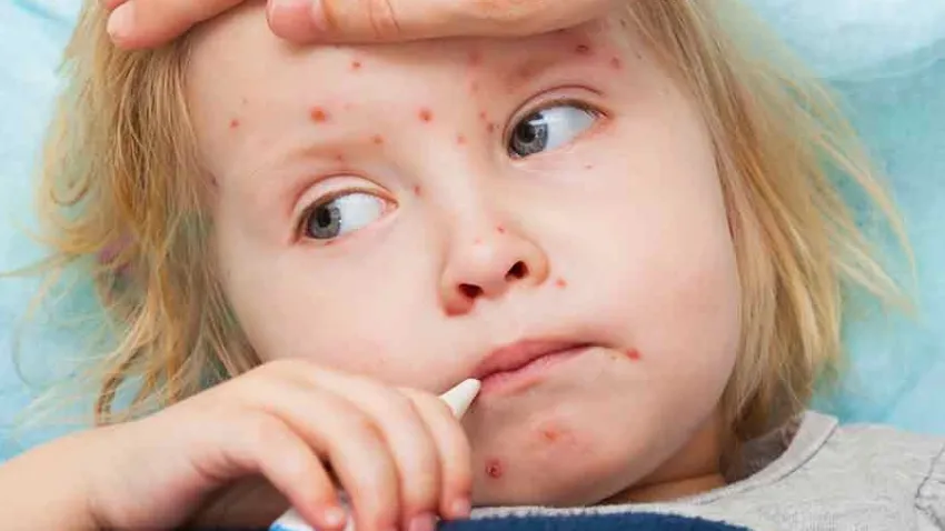 Kızamık hastalığı nedir? İşte kızamık belirtileri haberinin görseli