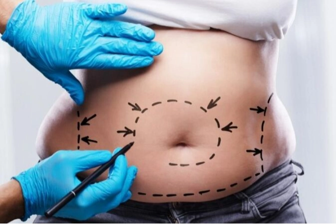 Uzmanından liposuction ile ilgili bilgiler