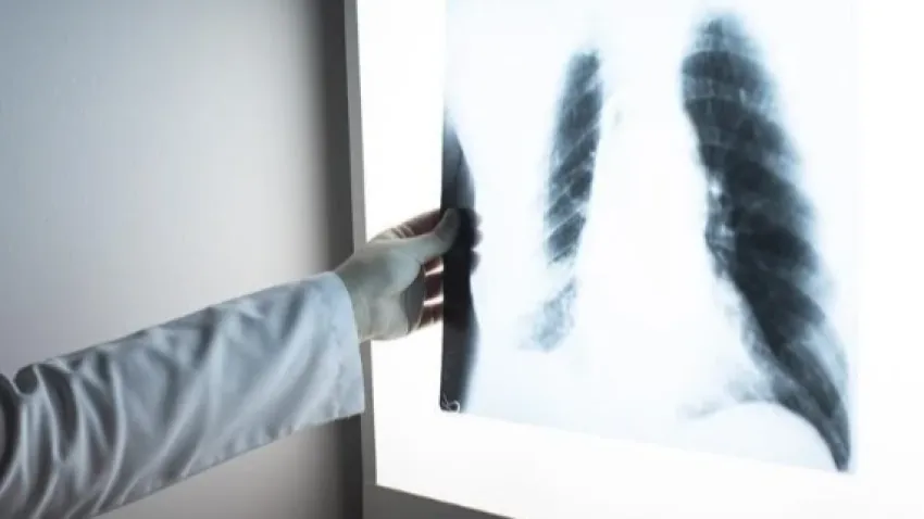Dünyada erkeklerde en sık akciğer görülüyor haberinin görseli