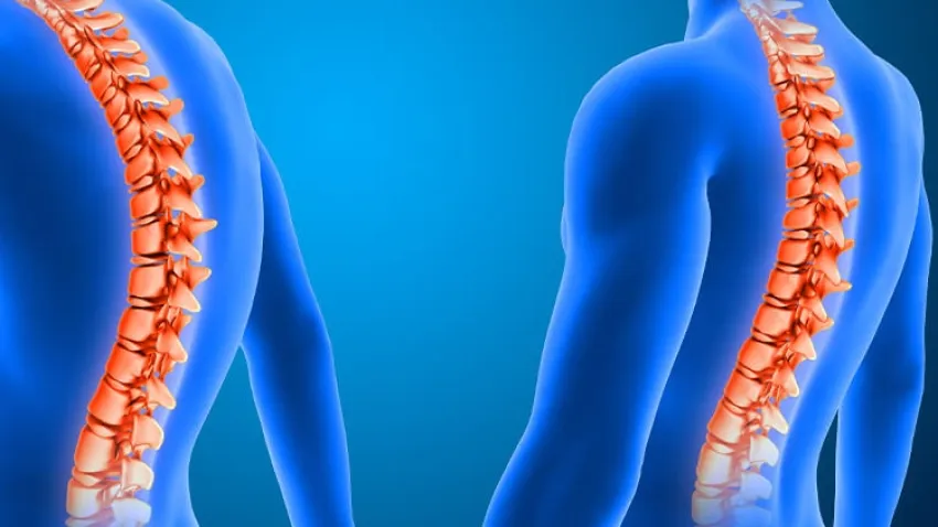 Skolyoz kız çocuklarında daha sık görülüyor haberinin görseli