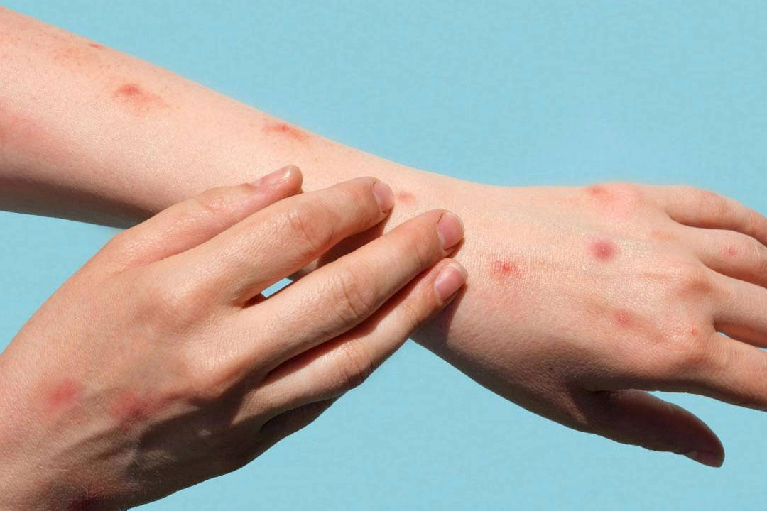 Hekimler mpox’tan ne zaman şüphelenmeli? haberinin görseli