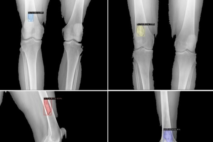 Yapay zeka ile kemik dokusu üzerindeki tümörü tespiti