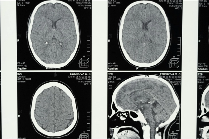 REM uykusundaki aksaklık, Alzheimer'ın erken işareti olabilir