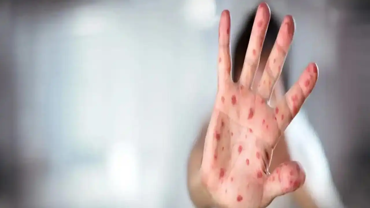 ABD’de kızamık alarmı: Vaka sayısı 600’ü aştı