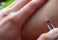 Türkiye’de kene alarmı: İzmir’de de görülmeye başlandı