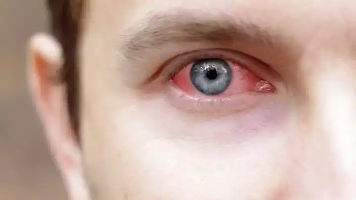 Adenovirüs nedir? Adenovirüsün belirtileri nelerdir? Adenovirüs nasıl bulaşır?
