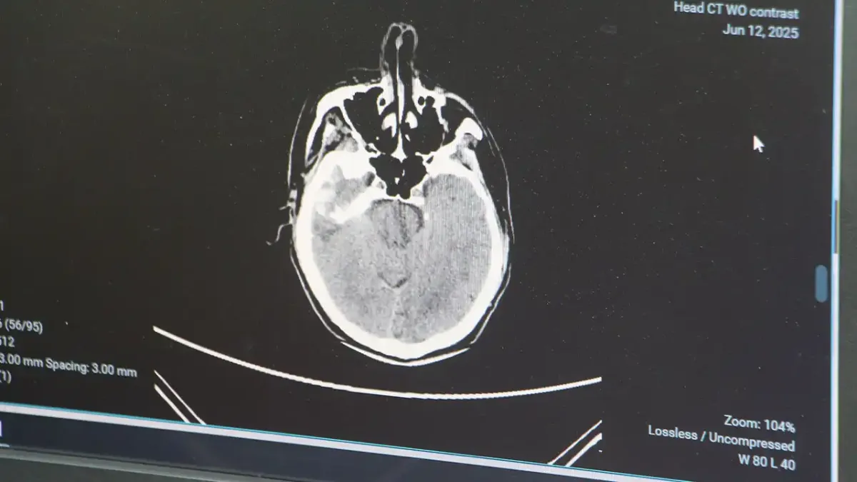 Gençlerde beyin kanaması vakaları artış gösteriyor haberinin görseli