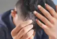 Alışkanlıklarınız saçınızı döküyor olabilir: Masum görünen içecekler kelliğe neden oluyor!