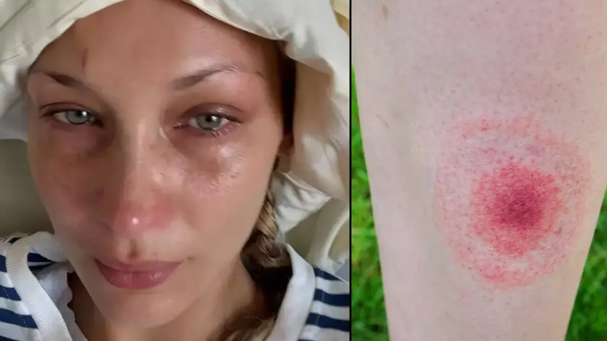 Lyme hastalığı nedir, belirtileri nelerdir? Lyme hastalığı tedavisi| Bella Hadid nasıl lyme hastası oldu? haberinin görseli