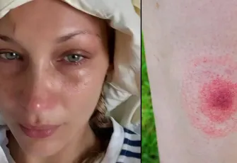 Lyme hastalığı nedir, belirtileri nelerdir? Lyme hastalığı tedavisi| Bella Hadid nasıl lyme hastası oldu?