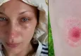 Lyme hastalığı nedir, belirtileri nelerdir? Lyme hastalığı tedavisi| Bella Hadid nasıl lyme hastası oldu?