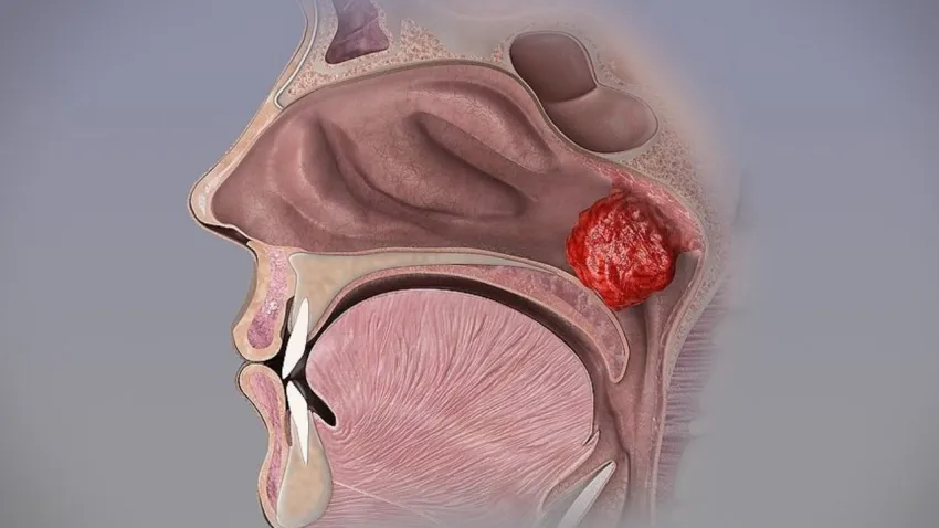 Çocuklarda geniz eti tehlikesi: Sinsice ilerleyip hayati risklere yol açabiliyor haberinin görseli