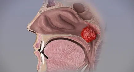Çocuklarda geniz eti tehlikesi: Sinsice ilerleyip hayati risklere yol açabiliyor