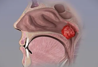 Çocuklarda geniz eti tehlikesi: Sinsice ilerleyip hayati risklere yol açabiliyor