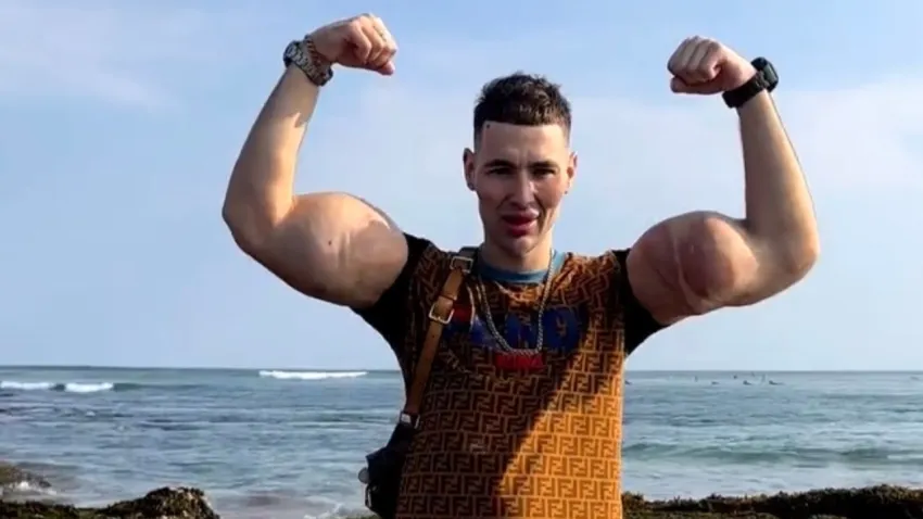 Yıllarca enjekte ettiği kimyasallar kabusa dönüştü: Rus Temel Reis ölüm tehlikesiyle karşı karşıya! İki kolunu da kaybedebilir haberinin görseli