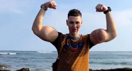 Yıllarca enjekte ettiği kimyasallar kabusa dönüştü: Rus Temel Reis ölüm tehlikesiyle karşı karşıya! İki kolunu da kaybedebilir