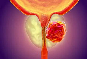 50 yaş üstü her erkek bu testi yaptırmalı!