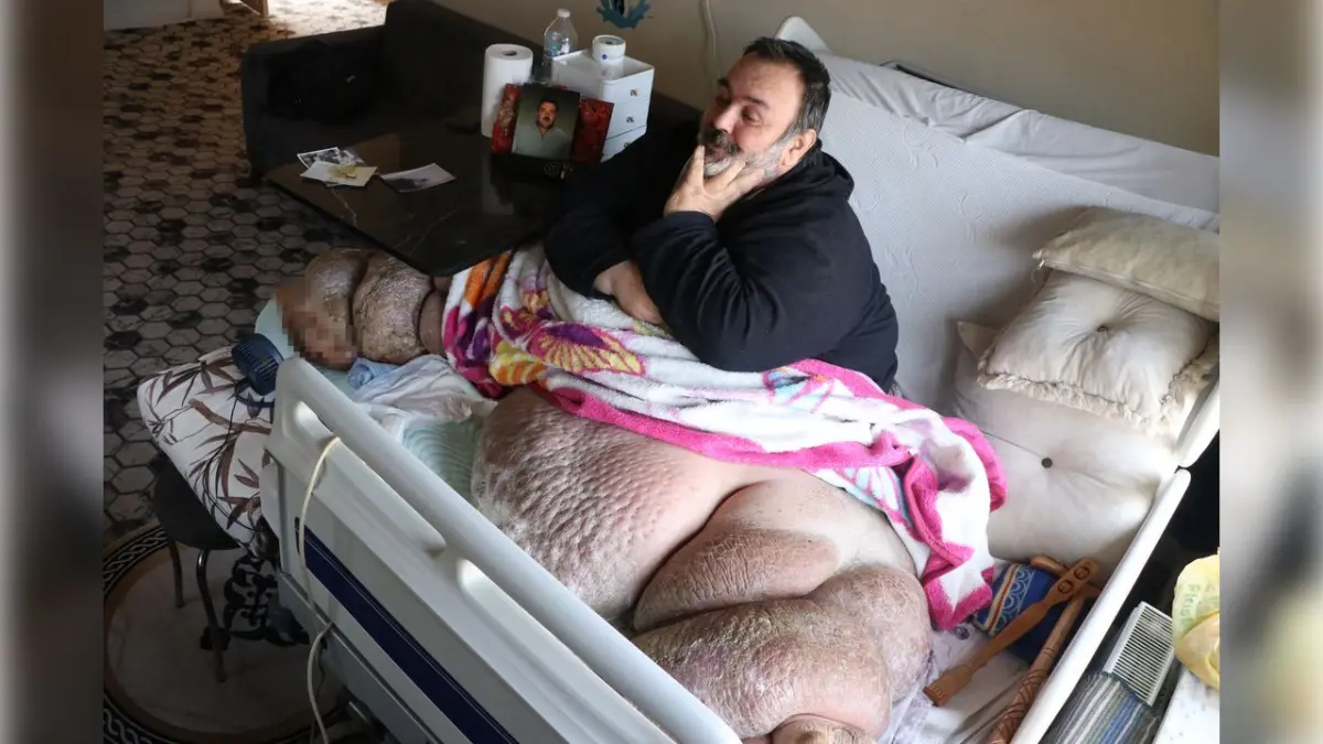 Fil hastalığı yatağa mahkum etti: En büyük özlemi eşiyle kol kola yürüyebilmek haberinin görseli