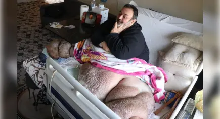 Fil hastalığı yatağa mahkum etti: En büyük özlemi eşiyle kol kola yürüyebilmek