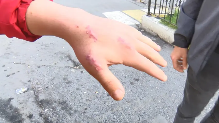 Kedi ısırığı sonrası hastaneye gitti, tendon kopması için şikayetçi oldu haberinin görseli