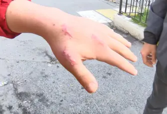 Kedi ısırığı sonrası hastaneye gitti, tendon kopması için şikayetçi oldu