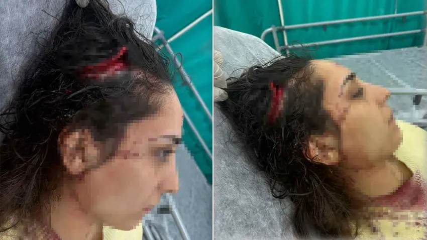 Bakkala giderken sokak köpeklerinin saldırısına uğradı: Genç kadının başında 20 santimetrelik açık oluştu! haberinin görseli