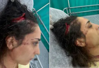 Bakkala giderken sokak köpeklerinin saldırısına uğradı: Genç kadının başında 20 santimetrelik açık oluştu!