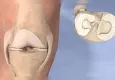 Geçmeyen diz ağrınızın nedeni menisküs yırtığı olabilir!