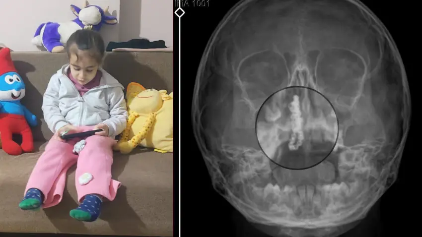 5 yaşındaki kızın burnundan 2 yıllık tırnak makası zinciri çıkarıldı haberinin görseli