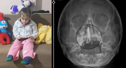 5 yaşındaki kızın burnundan 2 yıllık tırnak makası zinciri çıkarıldı