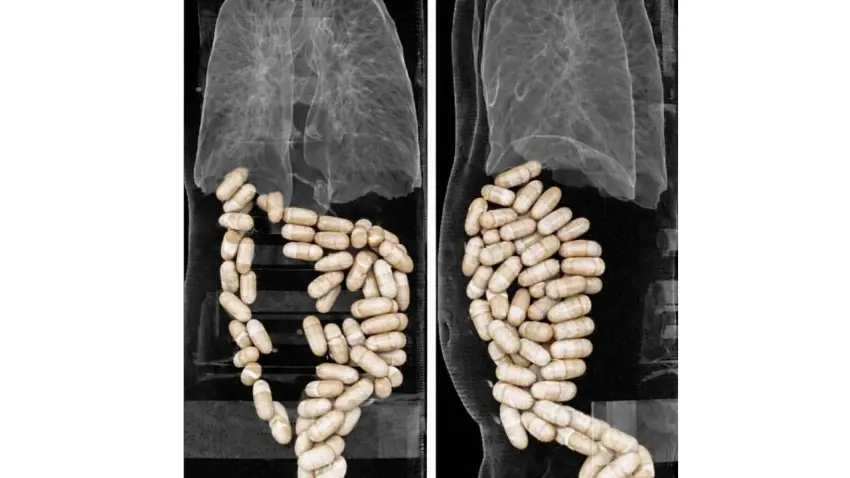 Midelerinden 1 kilo 304 gram uyuşturucu madde çıktı haberinin görseli
