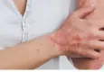 Sedef hastalığı tüm vücudu etkiliyor