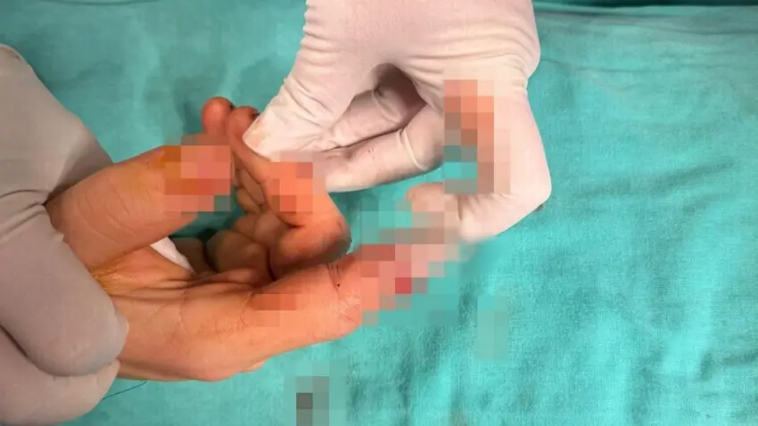 Kopan parmak vakalarında zamanla yarış çok önemli! haberinin görseli