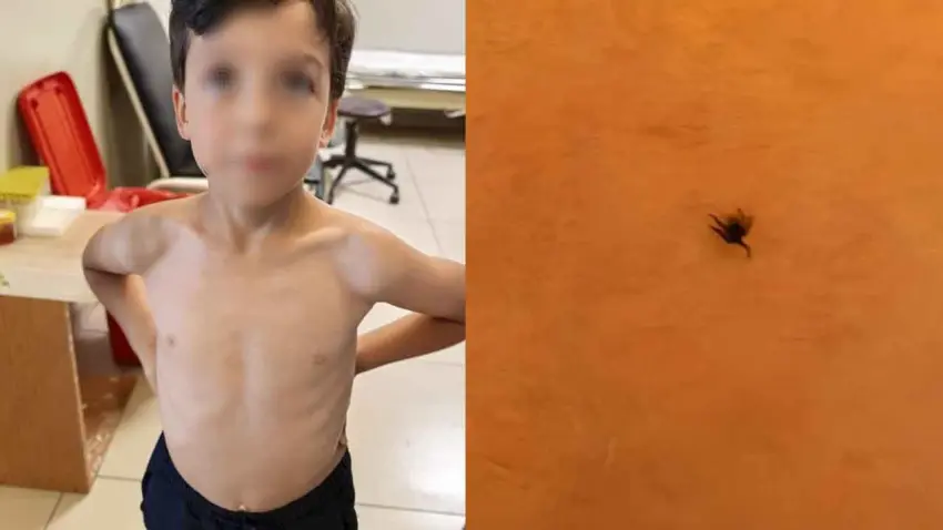 Küçük Mustafa'nın göğsüne kene yapıştı haberinin görseli